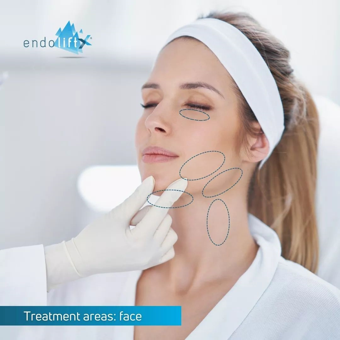 Endolift Treatments Laser Facial Southampton Endolift Treatments Laser Facial Southampton