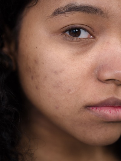 Get rid of scars at CJA Aesthetics Clinics in Hampshire Get rid of scars at CJA Aesthetics Clinics in Hampshire