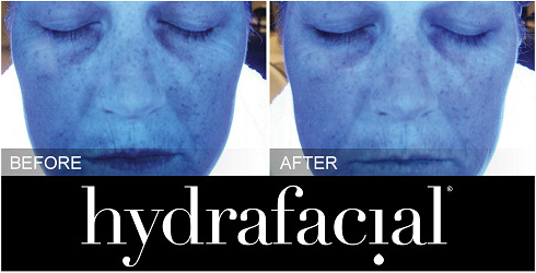 HydraFacial Before and After 1 HydraFacial Before and After 1