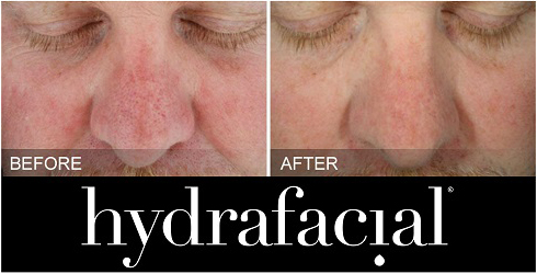 Spring Thread Lift Before and After 1 Spring Thread Lift Before and After 1