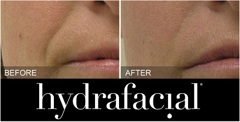 HydraFacial Before and After 1 HydraFacial Before and After 1