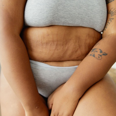 Improve stretch marks with RF Microneedling at CJA Clinics in Hampshire Improve stretch marks with RF Microneedling at CJA Clinics in Hampshire