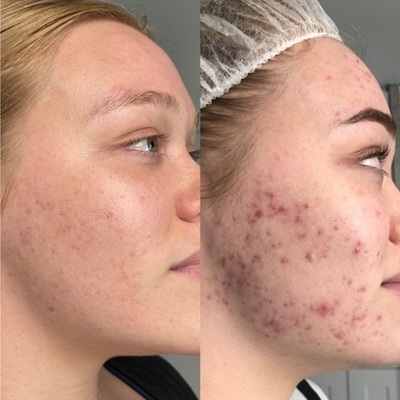 LED Light Therapy for Acne treatments in Hamsphire LED Light Therapy for Acne treatments in Hamsphire