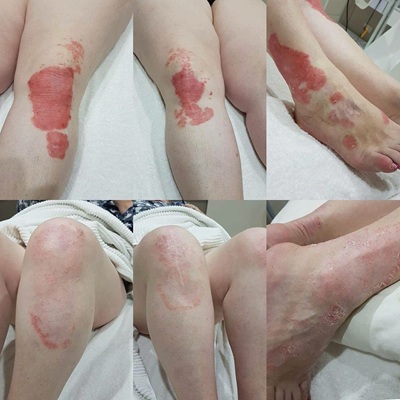 LED Light Therapy for Psoriasis CJA Clinics in Hampshire LED Light Therapy for Psoriasis CJA Clinics in Hampshire