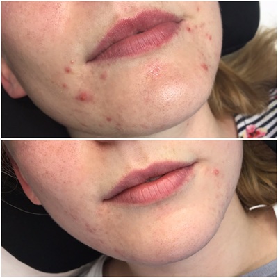 LED Light Therapy for acne at CJA Clinics, Hampshire LED Light Therapy for acne at CJA Clinics, Hampshire