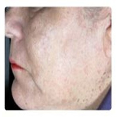 Laser Mole Removal Southampton Hampshire (1)