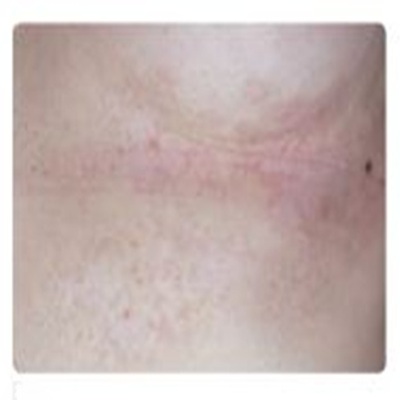 Laser Mole Removal Southampton Hampshire