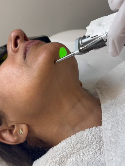 Nd:YAG laser treatments Southampton CJA Aesthetics Lynton laser ND YAG Southampton Clinic CJa Aesthetics