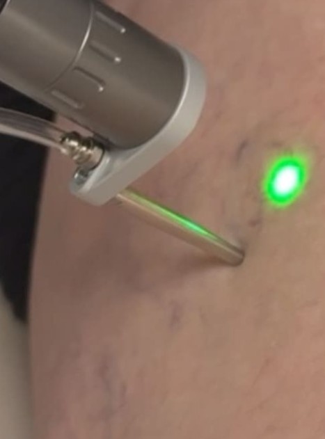 Lynton laser thread vein removal at CJA Aesthetics Clinics Hampshire Lynton laser thread vein removal at CJA Aesthetics Clinics Hampshire