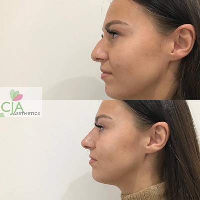 Non surgical nose jobs at CJA Aesthetic Clinics in Hampshire Non surgical nose jobs at CJA Aesthetic Clinics in Hampshire