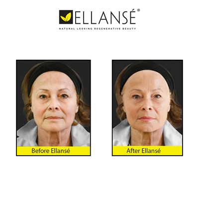 Reduce wrinkles with Ellanse Dermal Fillers at CJA Aesthetics Southampton Reduce wrinkles with Ellanse Dermal Fillers at CJA Aesthetics Southampton