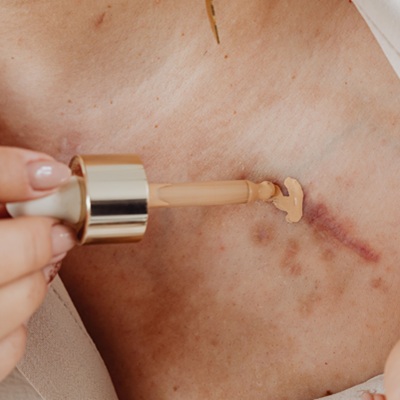 Scar treatments near me Scar treatments near me