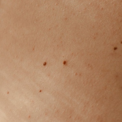 Skin Tag removal with lasers at top hampshire aesthetics clinics Skin Tag removal with lasers at top hampshire aesthetics clinics