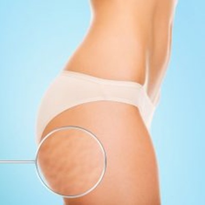 Stretch mark treatments near me Stretch mark treatments near me