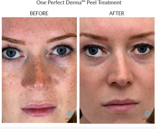 The Perfect Derma Peel Before and After