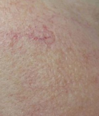 Thread veins after laser removal at CJA Aesthetics Hampshire