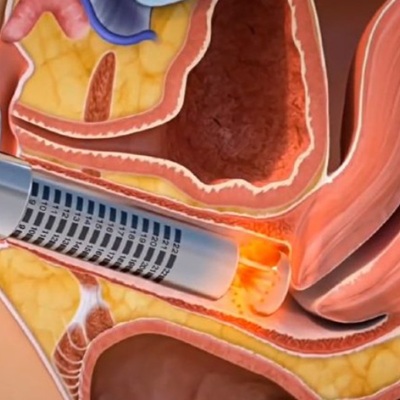 Vagina rejuvenation treatments at cja aesthetics clinics hampshire Vagina rejuvenation treatments at cja aesthetics clinics hampshire