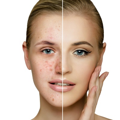 acne treatments at CJA Aesthetics in Southampton and Winchester acne treatments at CJA Aesthetics in Southampton and Winchester