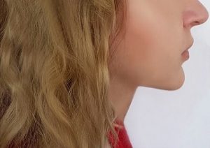 after double chin treatment in Hampshire