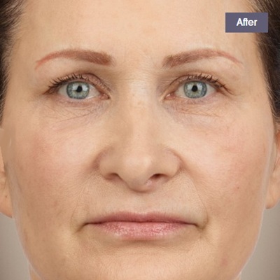 after fillers at cja aesthetics clinics hampshire
