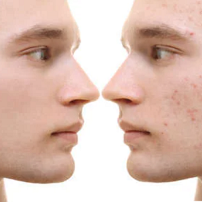 best acne scar treatments near me best acne scar treatments near me