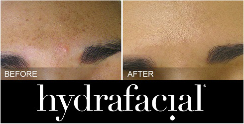 HydraFacial Before and After 1 HydraFacial Before and After 1