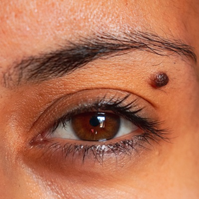 laser mole removal at cja aesthetics clinics hampshire laser mole removal at cja aesthetics clinics hampshire