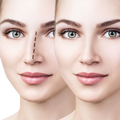 non surgical rhinoplasty nose job near me non surgical rhinoplasty nose job near me