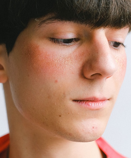 rosacea treatments at cja aesthetics clinics portsmouth, southampton, winchester rosacea treatments at cja aesthetics clinics portsmouth, southampton, winchester