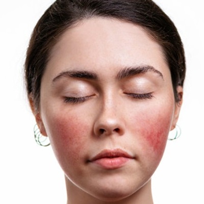rosacea treatments near me rosacea treatments near me