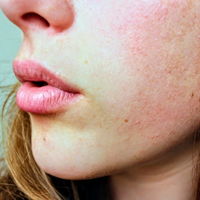 rosacea treatments with RF Microneedling near me rosacea treatments with RF Microneedling near me