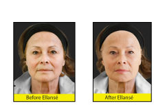 Reduce-wrinkles-with-Ellanse-Dermal-Fillers-at-CJA-Aesthetics-Southampton