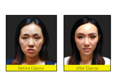Smoother-Skin-with-Ellanse-anti-aging-Treatments-at-CJA-Aesthetics-Hampshire