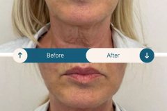 Before-and-After-Endolift-Treatment