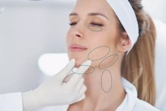 Endolift-Treatments-Laser-Facial-Southampton