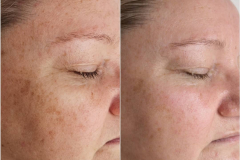 Flex-MD-Pigmentation