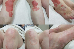 Psoriasis-20-Treatments