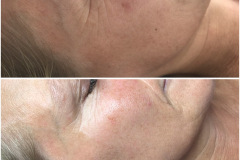 Tri-Wave-Rejuvenation