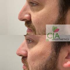 Liquid-Rhinoplasty-Porstmouth-CJA-Aesthetics-Clinics