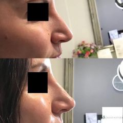 Non-Surgical-Rhinoplasty-Hampshire-Aesthetics-Clinics