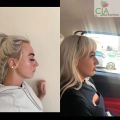 Non-Surgical-Rhinoplasty-Hampshire-CJA-Aesthetics-Clinics